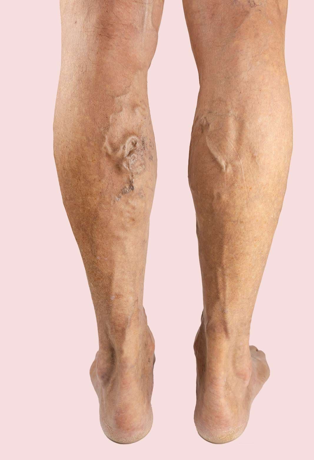 Spider Vein Removal Treatment