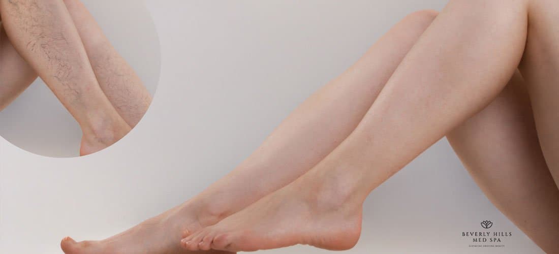 how-to-get-rid-of-spider-veins-Beverly-Hills-Med-Spa