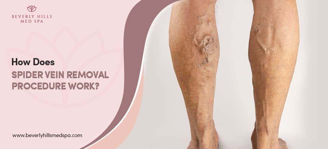 How Does Spider Vein Removal Procedure Work?