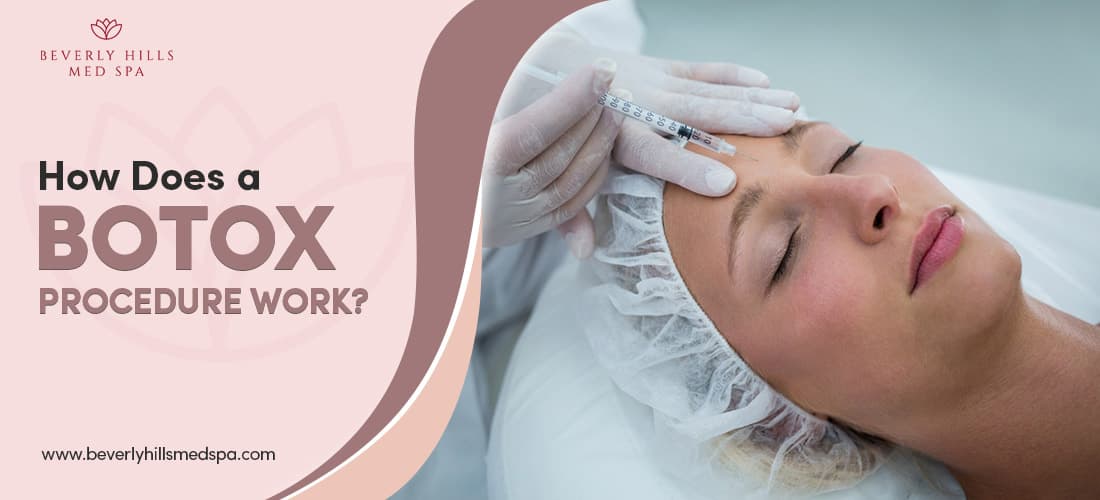 How Does a Botox Procedure Work Featured Image