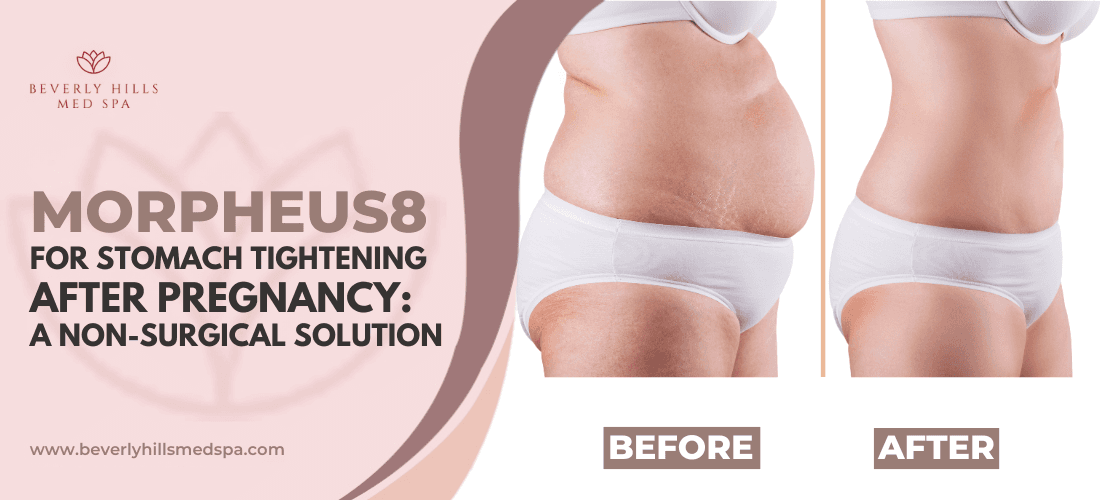 morpheus8-stomach-tightening-after-pregnancy