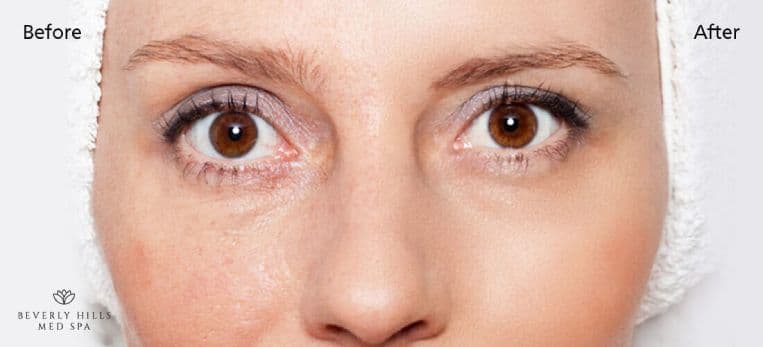 does microneedling work