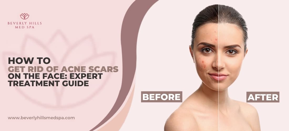 how-to-get-rid-of-acne-scars-on-face