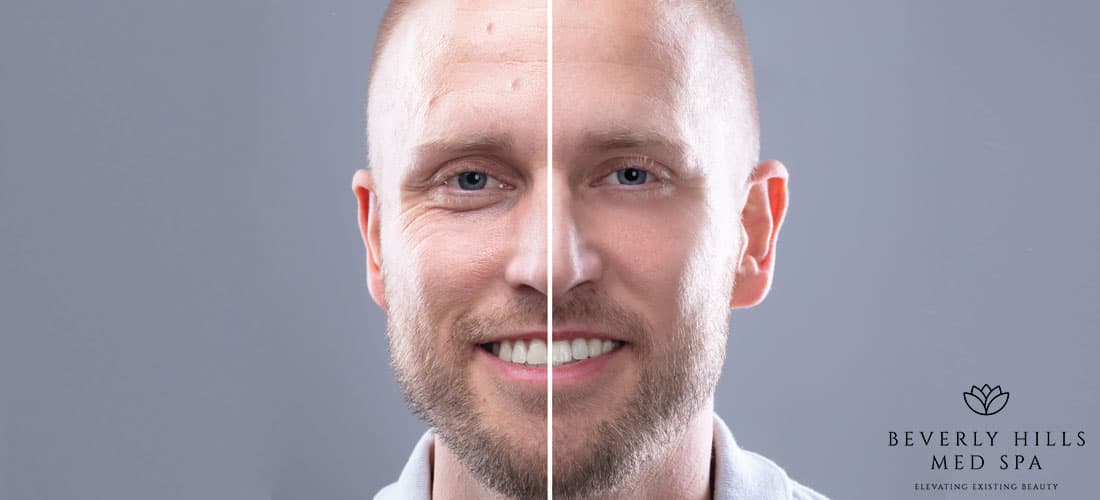 microneedling results how long does it take60e81afdbcc12