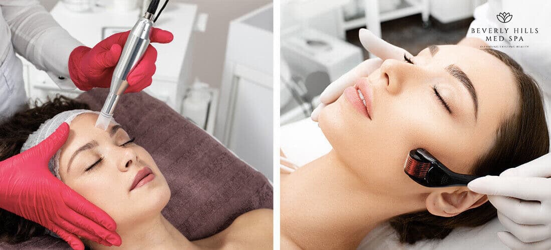 microneedling60b9d0d079ee3