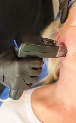 morpheus8 los angeles