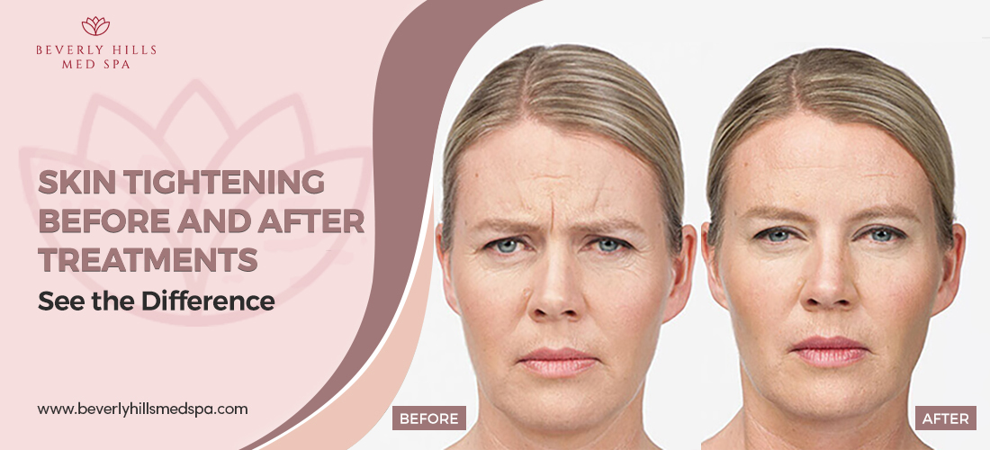 skin-tightening-before-and-after