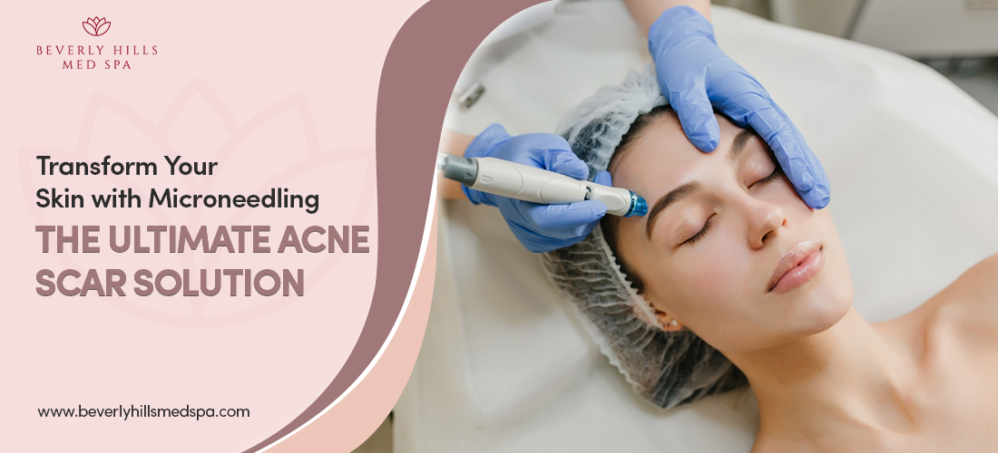 microneedling-for-acne-scars